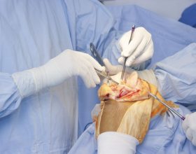 Amputations and Workers' Comp